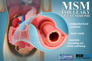 MSM for Leaky Gut Syndrome